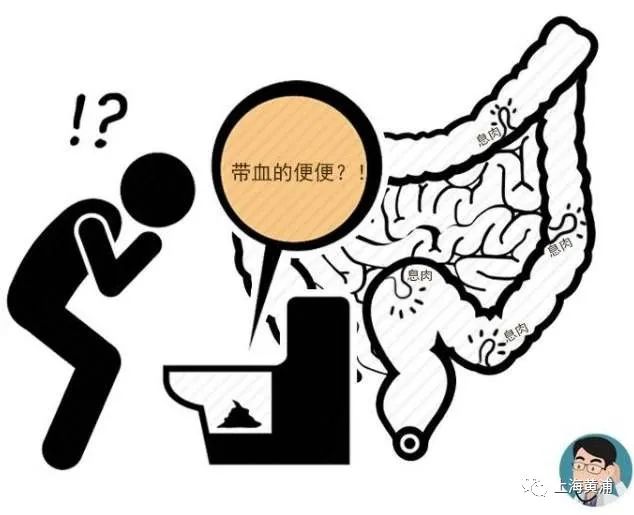 冬季得溃疡性结肠炎,如何治疗?