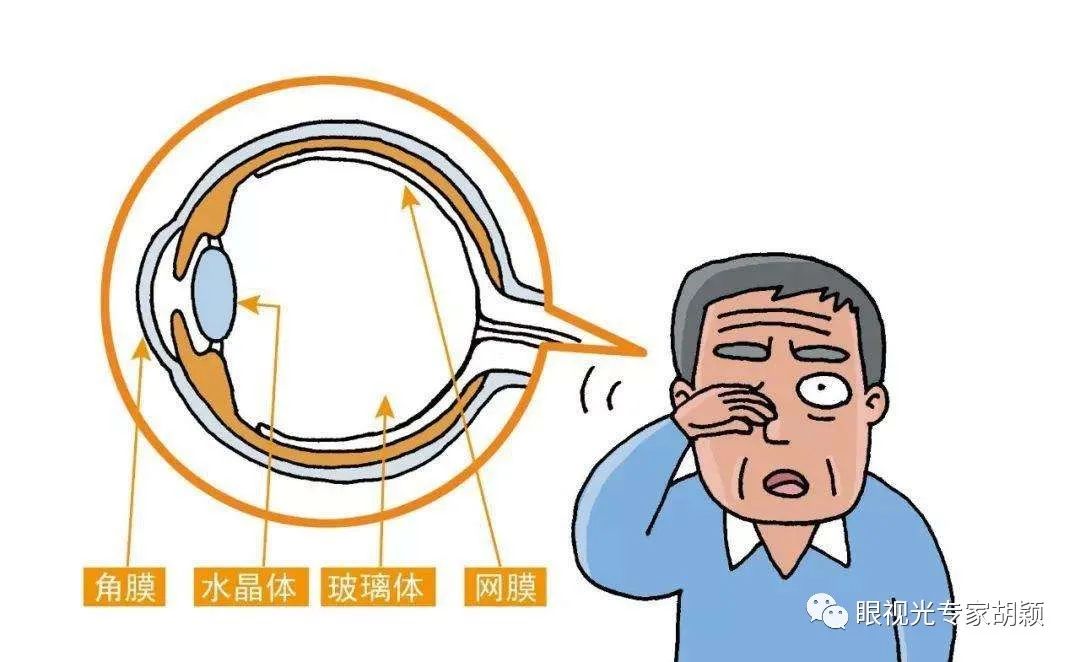 近视激光手术会影响日后白内障手术吗