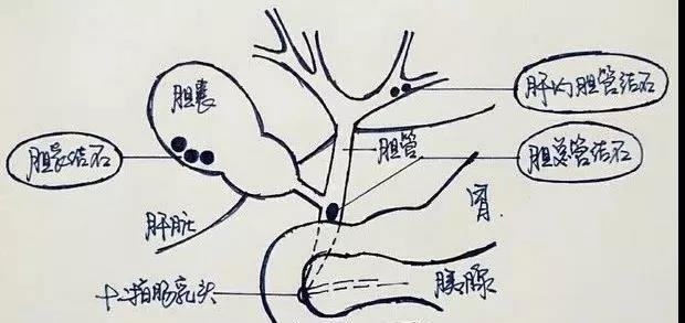 医学科普简话胆结石