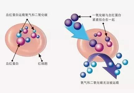 一氧化碳中毒是指由于吸入过多一氧化碳,一氧化碳与人体血红蛋白结合