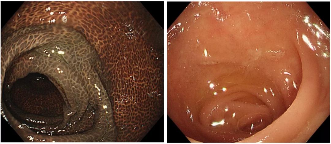 图:结肠黑变病肠黏膜 vs 正常肠黏膜 长期服用蒽醌类泻药是"肠子变黑