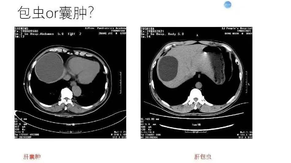 经过细致分析,考虑患者牧区接触史,诊断患者系肝包虫病