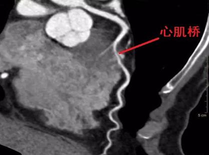 通过冠状动脉cta显示的心肌桥的覆盖厚度和长度可以诊断心肌桥及判断