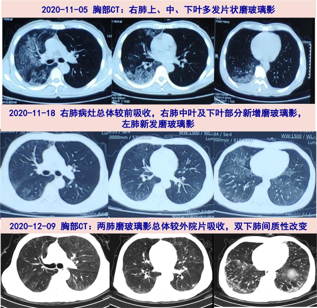 探案丨发热久治不愈,肺炎飘忽不定