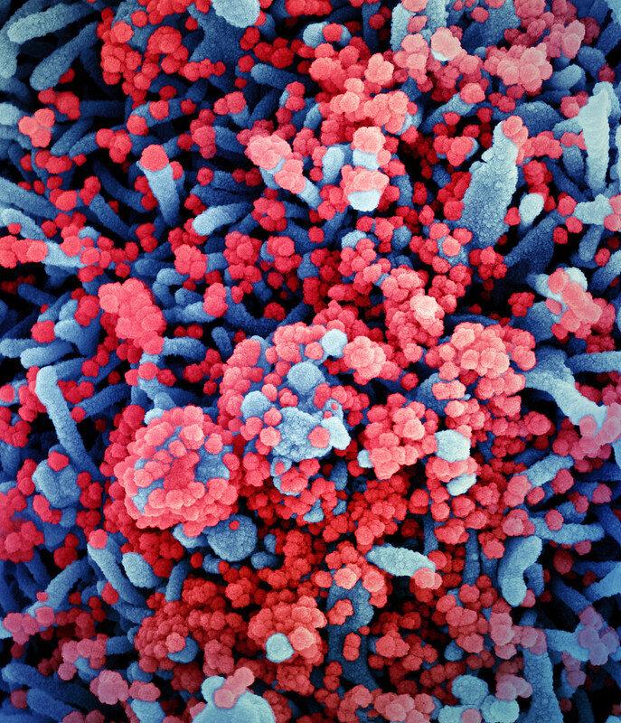 扫描电子显微镜下新冠病毒颗粒(红色)感染细胞(蓝色)的场景丨图源