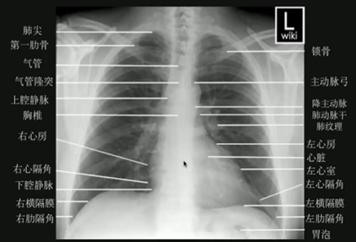 图1.正位(后前位)胸片解剖结构