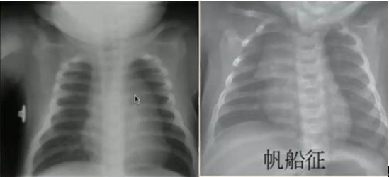 读完此文,终于会看儿童胸片了