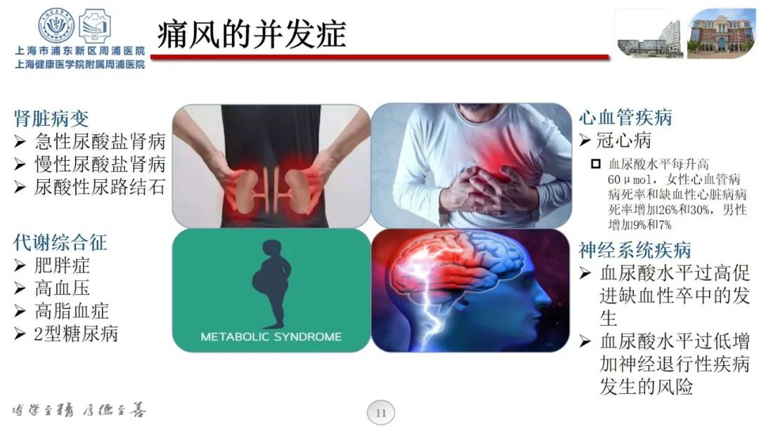 【科普课堂】痛风性关节炎可以用超声检查吗?