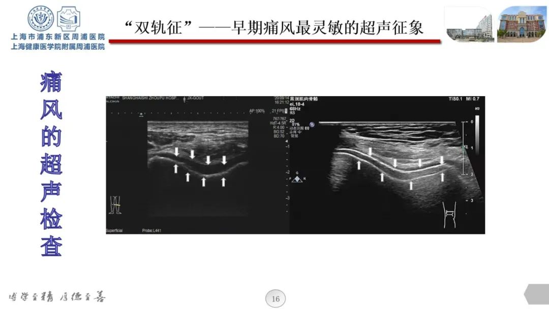 【科普课堂】痛风性关节炎可以用超声检查吗?