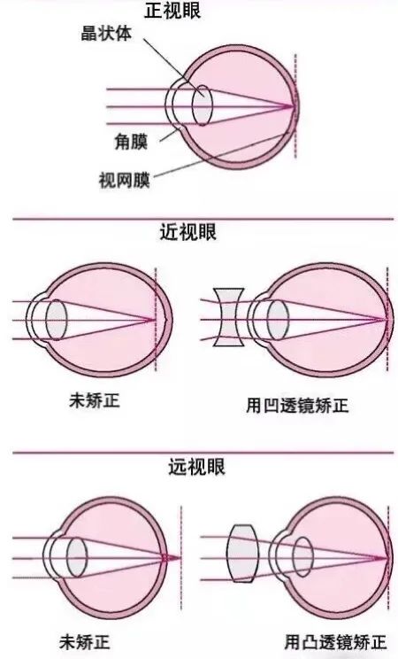 【小南话科普】孩子远视了,需不需要配眼镜呢?