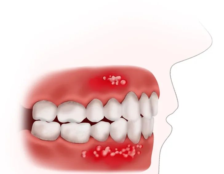 有医说医|牙龈上长了"瘤子"怎么办