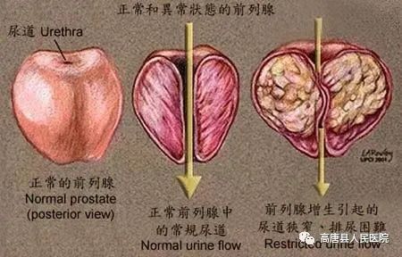 【健康小贴士】中老年男性的"男"言之隐——前列腺增生