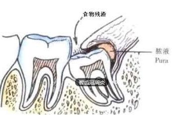 智齿反复发炎,能不拔吗?