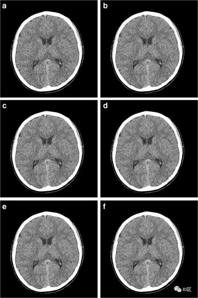 如何优化儿童头颅ct的图像质量