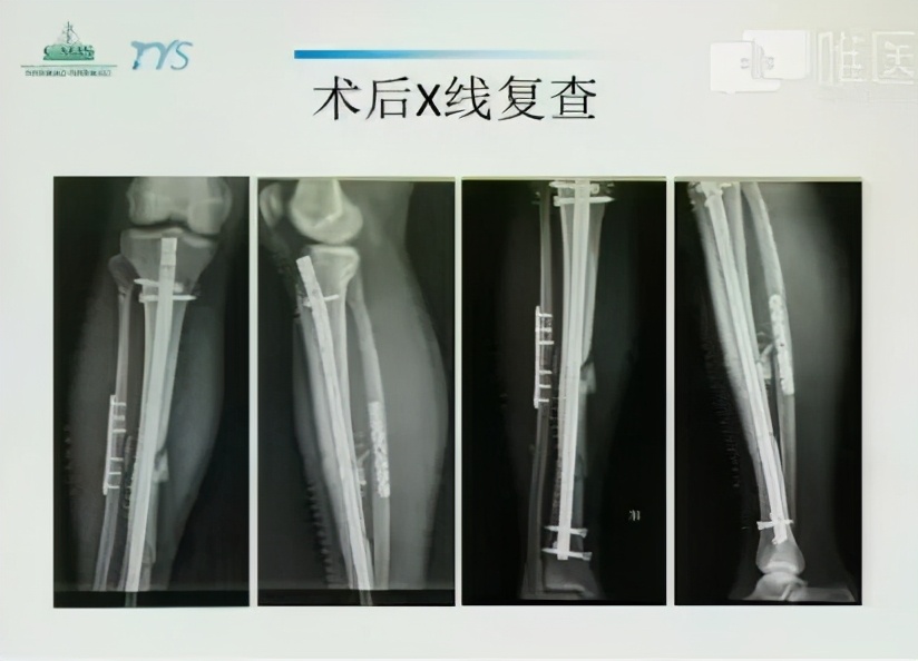 郑龙坡教授复杂胫腓骨多段骨折的治疗经验