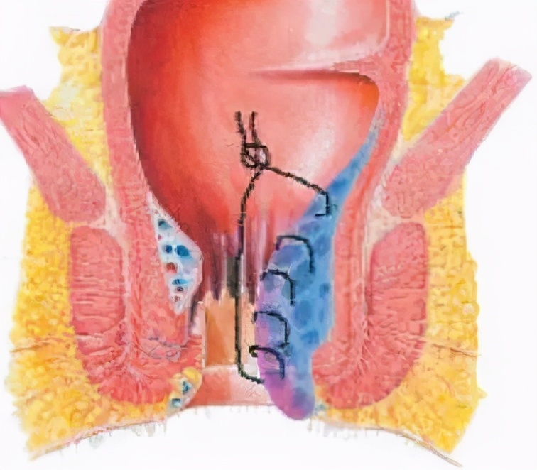 当天可出院的痔疮手术怎么做?