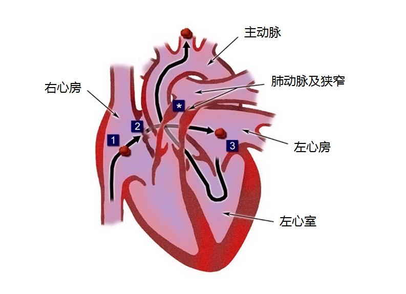 卵圆孔未闭导致卒中的机制,来自静脉系统的栓子通过异常通道进入体