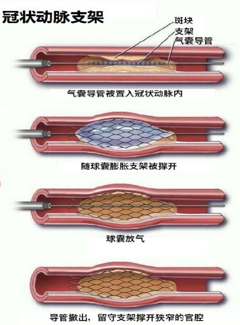 【专家讲科普】心内科梁春教授:3种冠状动脉支架有哪些你还不了解