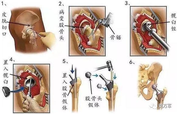 股骨头坏死怎么办?保头还是置换?