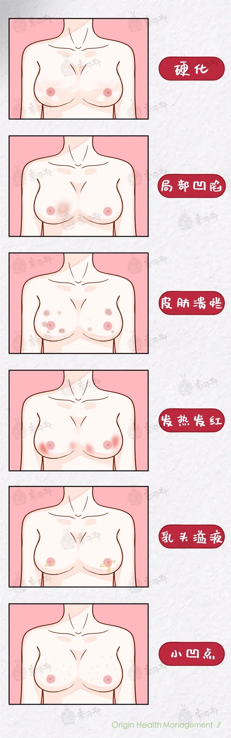 女性乳腺癌发病数首超肺癌:别生气了,真的要命