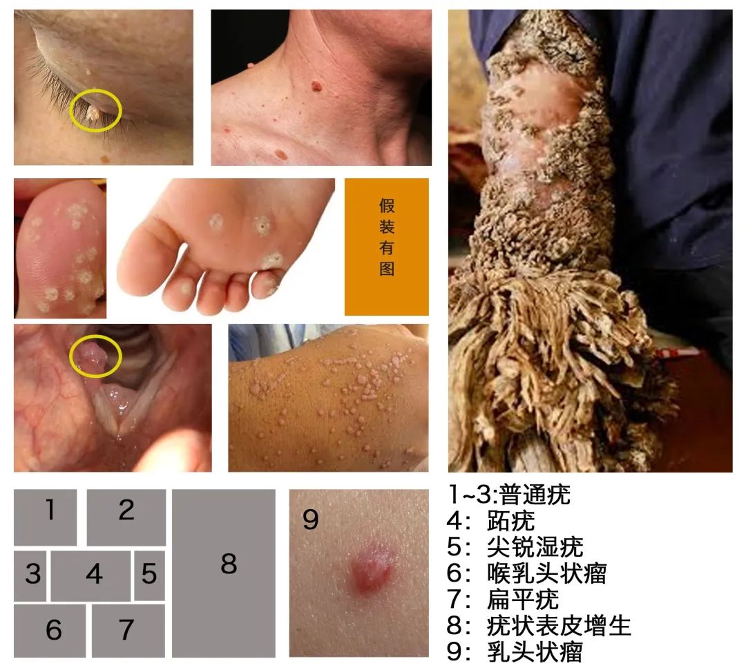 hpv疫苗打完就安全了吗?男生也要打吗?几岁打最有用?