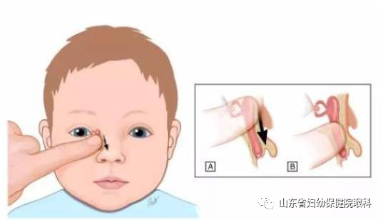 小宝宝总是泪眼汪汪妇幼专家教你如何进行鼻泪管阻塞按摩