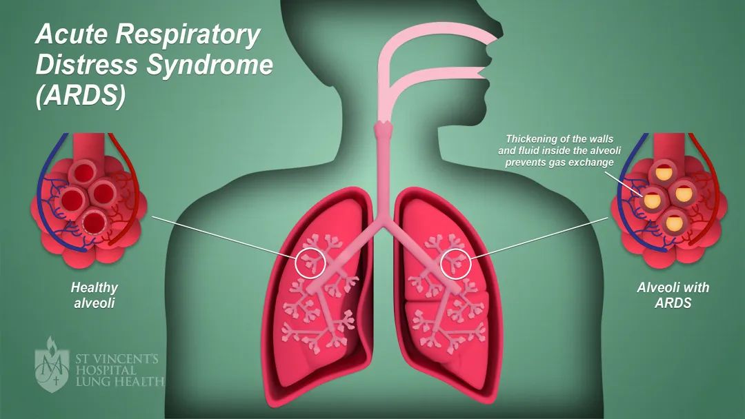 肺活检在急性呼吸窘迫综合征诊断中的安全性和可行性分析