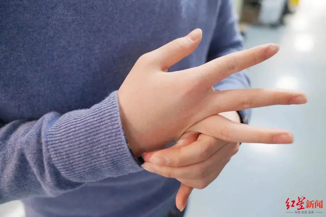 手指可任意折叠,天生骨骼清奇?医生:这是病!