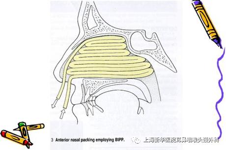 镜馨园 后鼻孔纱条填塞法 4,全身治疗:对由于鼻腔,鼻窦有复杂病变或因