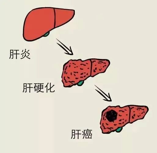 预防肝癌专家有话说