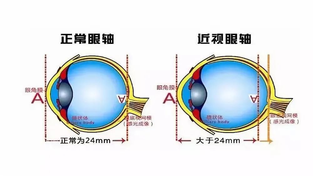 屈光检查,为什么要测眼轴?