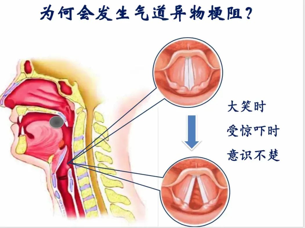 健康总动员气道异物梗阻应急处置都在这里