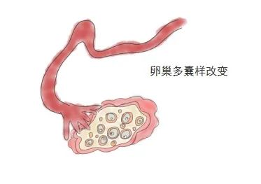 【科普】突然月经不规律,体重疯涨?多半是"多囊卵巢综合征"惹的祸