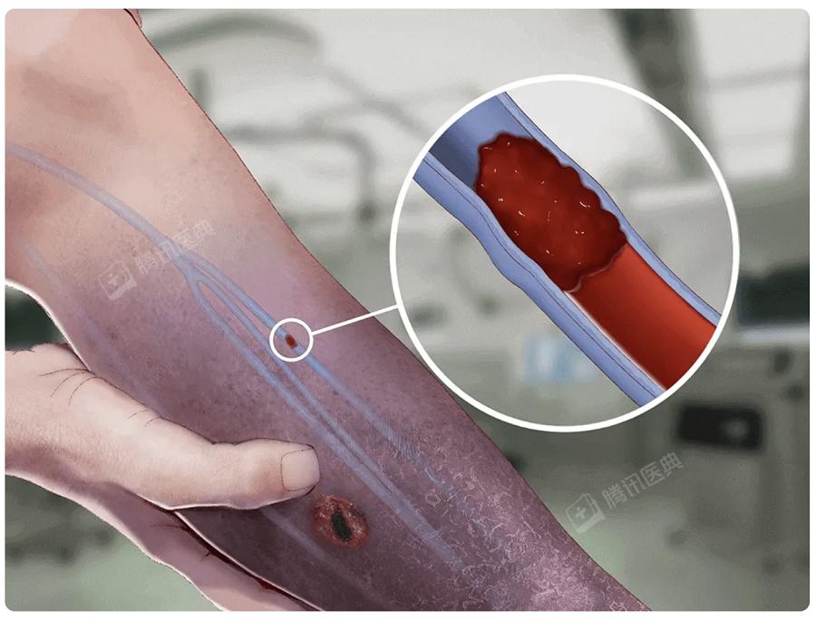 (下肢静脉血栓示意图)