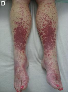 患者腹痛入院,双腿遍布紫色皮疹,这个病因你想得到吗?