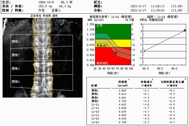 袁大妈近期的双能x线骨密度检查报告