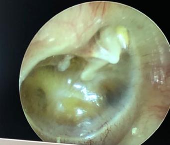 分泌性中耳炎:是以中耳积液,听力下降,而鼓膜完整为主要特征的中耳非