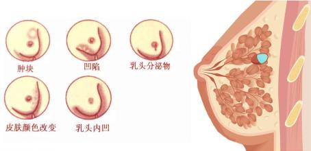 检查你的胸部,看看皮肤颜色或质地的变化,看看有没有乳头凹陷,注意