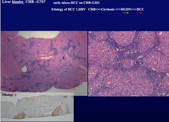 对于如下chb患者的病理切片,发现患者在肝硬化的背景下肝脏存在癌细胞