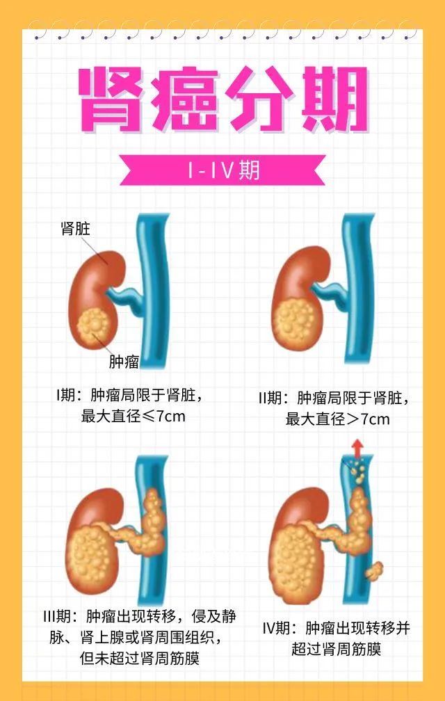 世界肾脏日科普∣肾癌的早期发现及预防