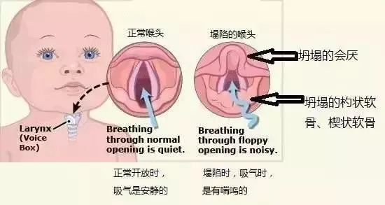 宝宝喉咙里总是呼呼啦啦,吃了化痰药不见好,原来是这个病