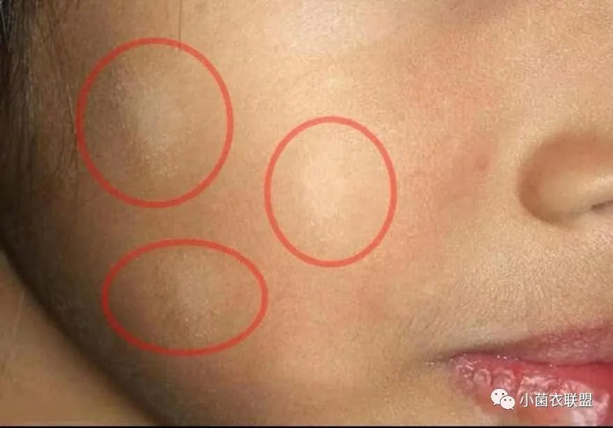 白癜风:是一种常见的后天色素脱失性皮肤黏膜病,任何年龄任何部位皮肤