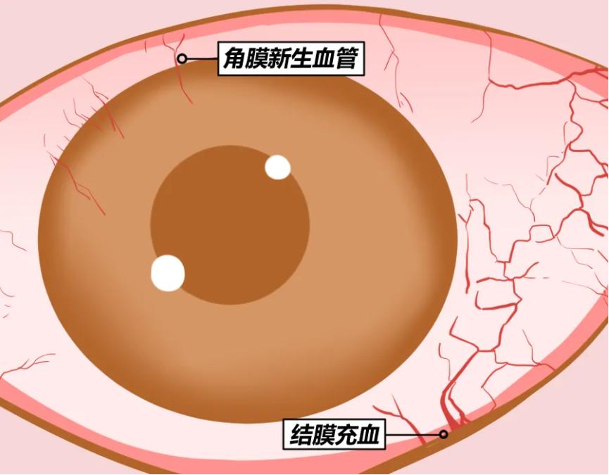 但如果缺氧太久,损伤太久,角膜里会有新生血管长出来(为了获得氧气)