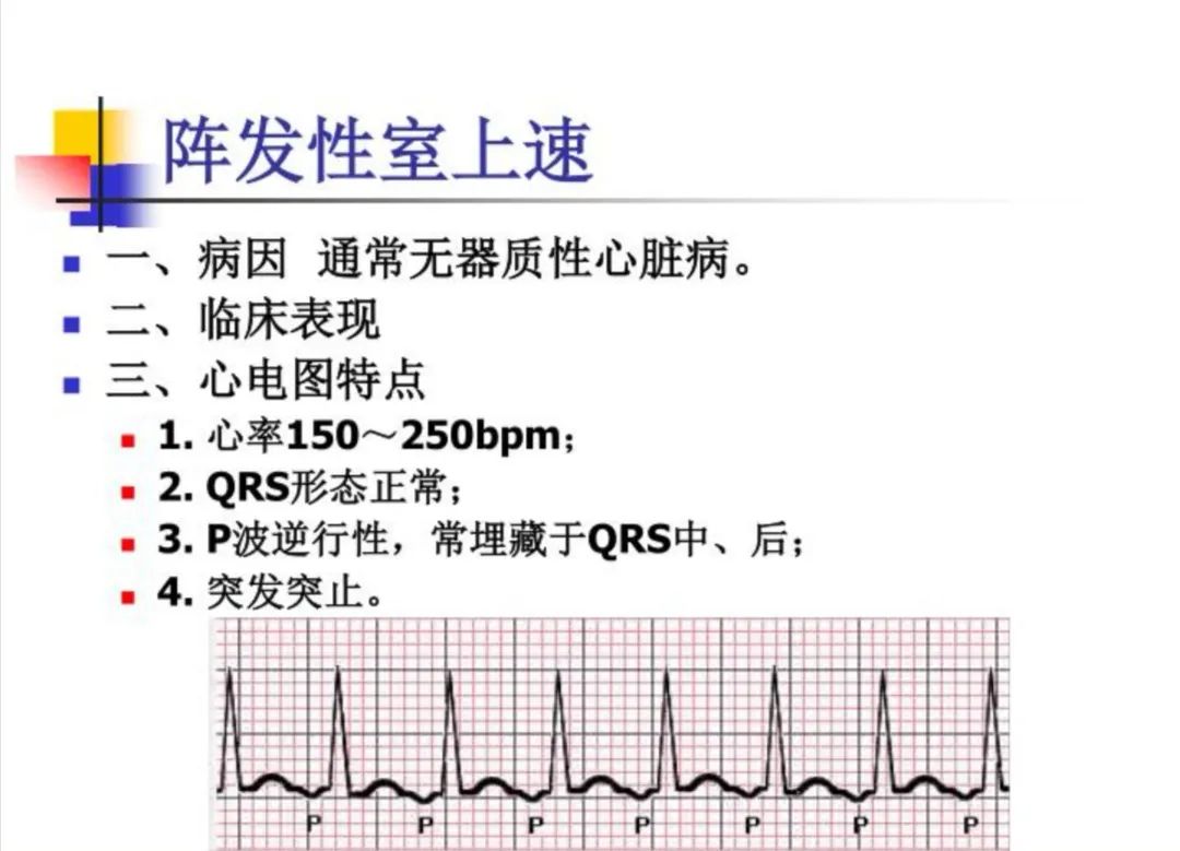 室上速患者如何自救?