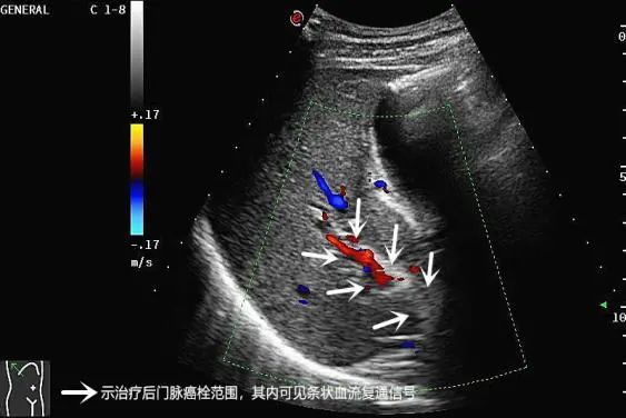 曙光动态我院超声医学中心成功运用高强度聚焦超声hifu治疗门静脉癌栓