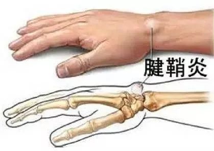 旋转手腕:当自我治疗腱鞘炎刺痛开始时,可以尝试旋转手腕的手部运动以