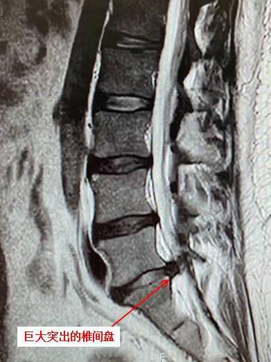 磁共振显示腰5骶1巨大突出的椎间盘