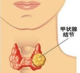 【甲状腺科普系列】查体发现甲状腺结节钙化,这是癌吗?