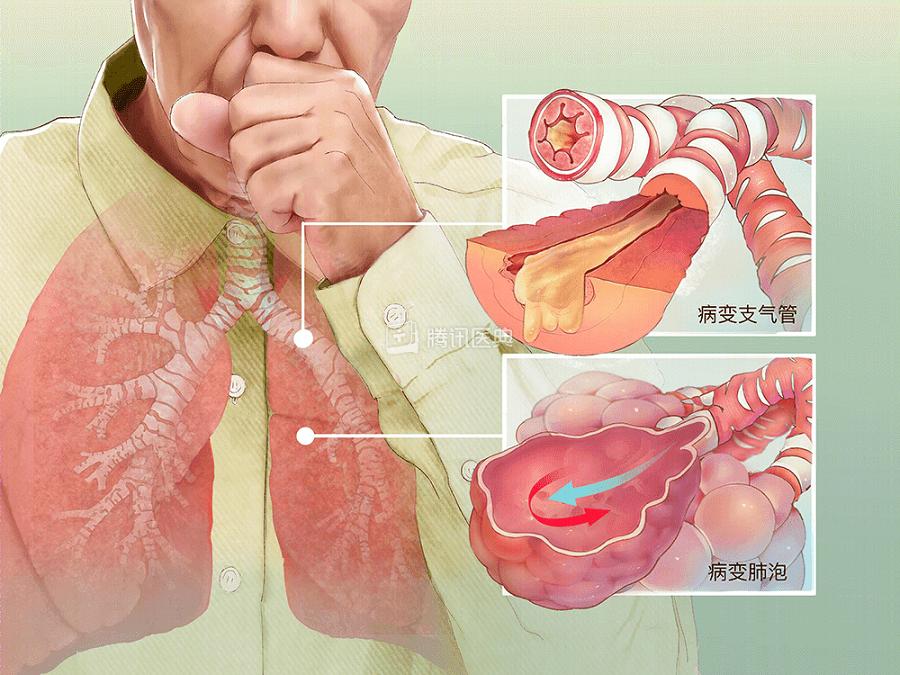 慢阻肺这个名字听起来比较陌生,但说起慢性支气管炎(老慢支),肺气肿