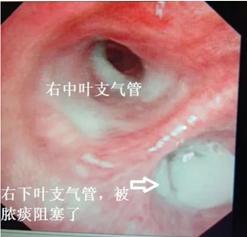 是否合并支气管异物?是否合并真菌感染?是否合并大气道狭窄等等.